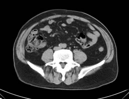 MRI法解析による「シニアエクササイズ」実施後の、大腰筋横断面積の変化